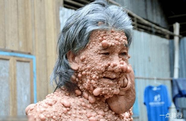 世界上十大必死病 艾滋病只能排第二(2024年最新排名前十榜单)